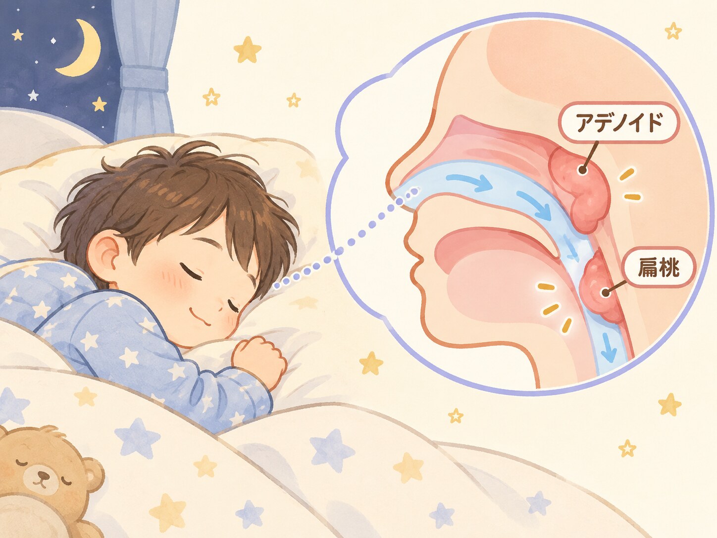 眠っているお子様と、アデノイド・扁桃によって狭くなった気道のイラスト